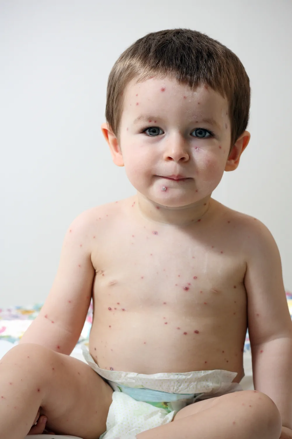 Baby with chickenpox