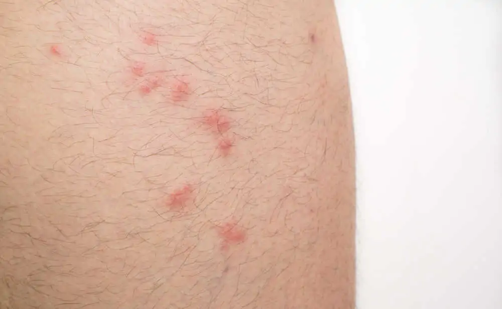 Flea bites