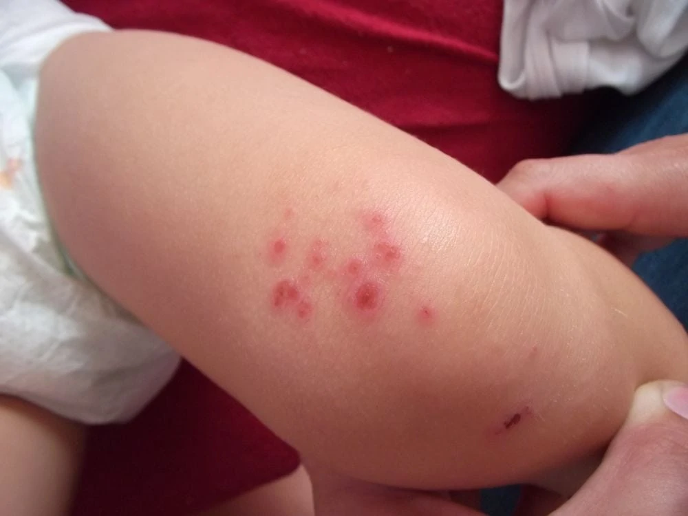 rashes on baby's knee